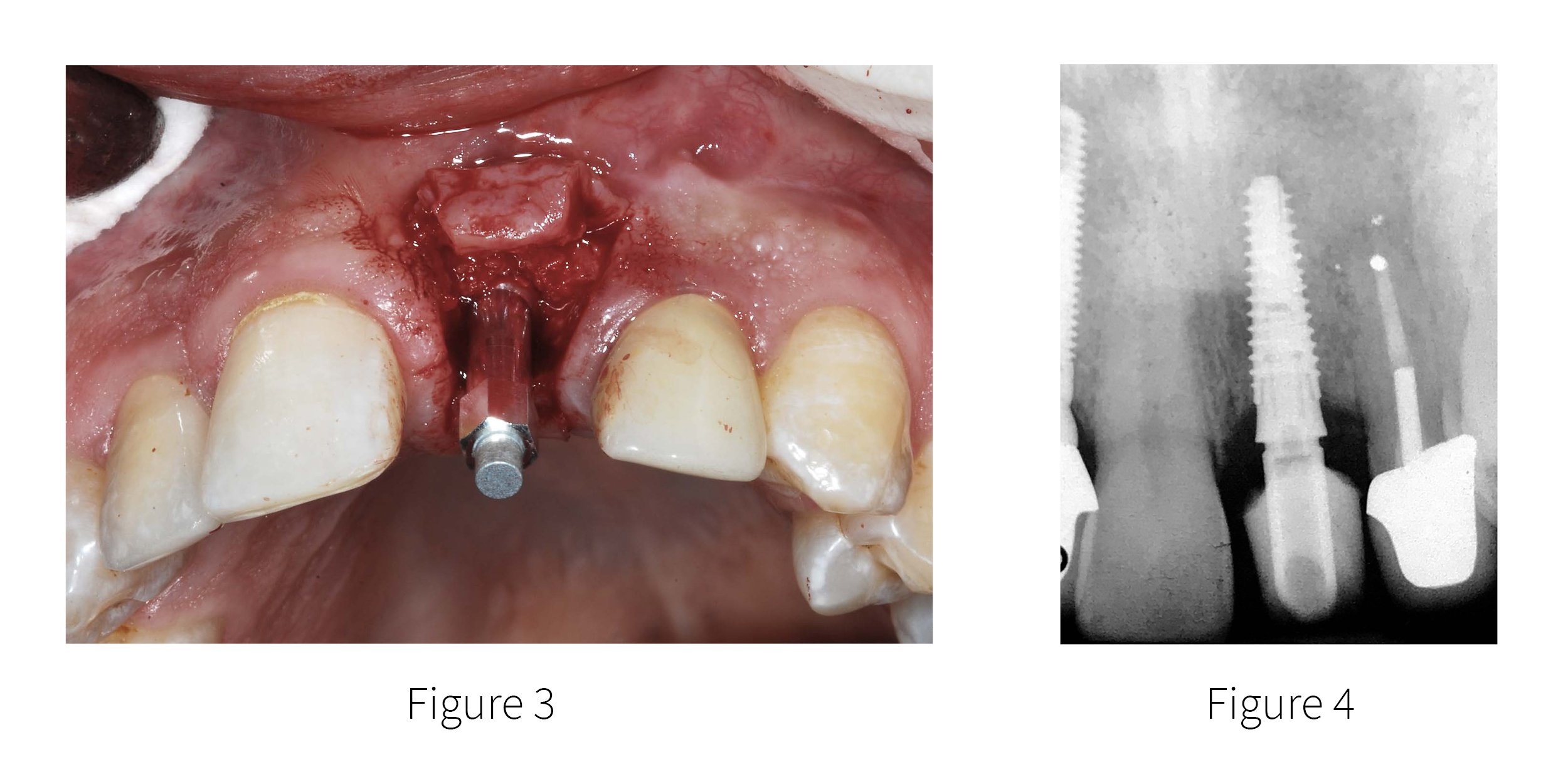Maxillary Central Incisor Implant Supported Crown Brief Case Report